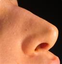 Rhinoplasty - Turkeyana Clinic