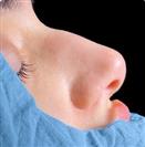 Rhinoplasty - Turkeyana Clinic