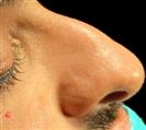 Rhinoplasty - Turkeyana Clinic