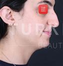 Rhinoplasty - Turkeyana Clinic