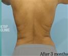 Liposuction - BELLAMODE Clinic