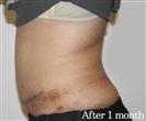 Tummy Tuck - BELLAMODE Clinic