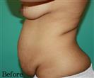 Tummy Tuck - BELLAMODE Clinic
