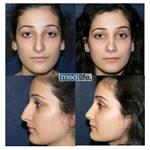 Rhinoplasty - Medlife Group