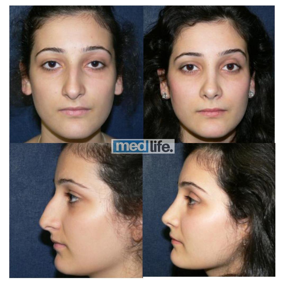Rhinoplasty - Medlife Group