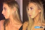 Rhinoplasty - Medlife Group