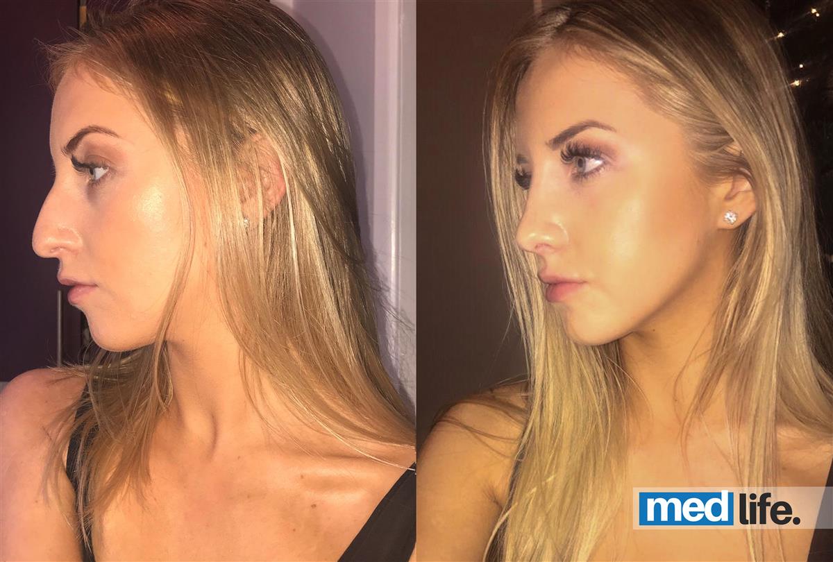 Rhinoplasty - Medlife Group