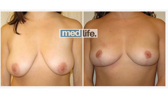 Breast Uplift - Medlife Group