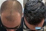 Hair Transplant - Medlife Group