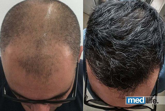 Hair Transplant - Medlife Group