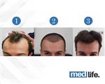 Hair Transplant - Medlife Group