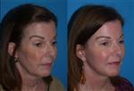 Face lift - Medlife Group