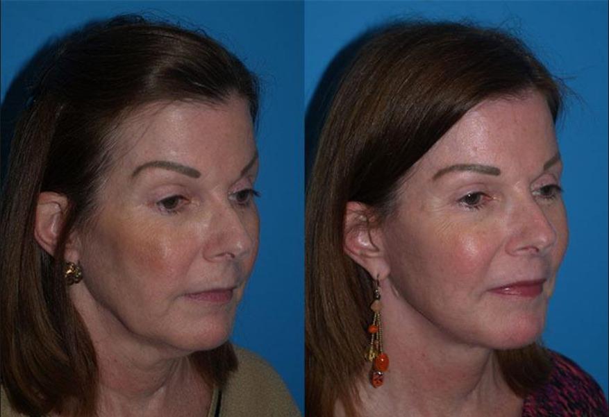 Face lift - Medlife Group