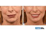 Face lift - Medlife Group