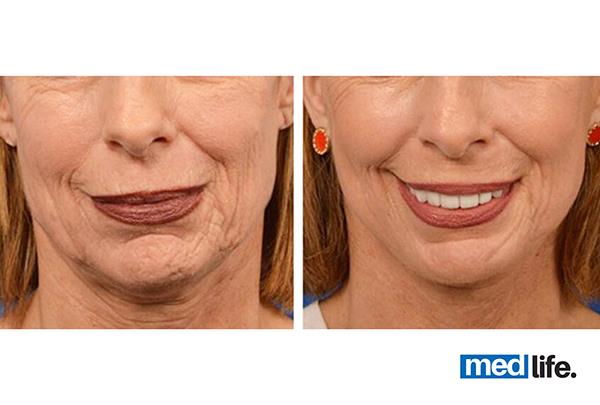 Face lift - Medlife Group