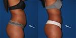 Liposuction - Medlife Group