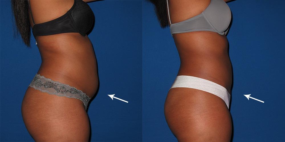 Liposuction - Medlife Group