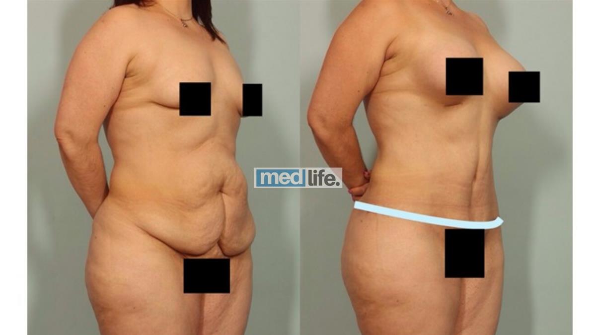 Mommy Makeover - Medlife Group