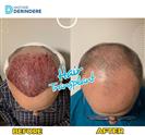 Hair Transplant - Derindere Hospital