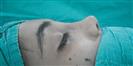 Rhinoplasty - Optimed Hospital