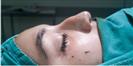 Rhinoplasty - Optimed Hospital