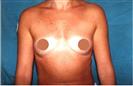 Breast  Augmentation Surgery - Optimed Hospital