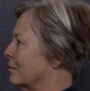 Face Lift + Chin Reduction Surgery - Hermes Clinics