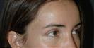 Botox (Forehead + Lower Eyelid) - Hermes Clinics
