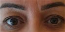 Botox (Lower Eyelid + Forehead) - Hermes Clinics