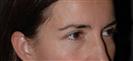Botox (Forehead + Lower Eyelid) - Hermes Clinics