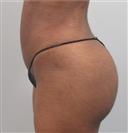 Brazilian Butt Lift - Hermes Clinics