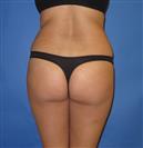 Brazilian Butt Lift - Hermes Clinics