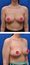Breast Lift - Hermes Clinics