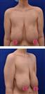 Breast Lift - Hermes Clinics