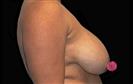 Breast Lift - Hermes Clinics