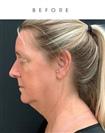 Chin Reduction Surgery - Hermes Clinics