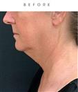 Chin Reduction Surgery - Hermes Clinics