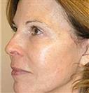 Face Lift - Hermes Clinics