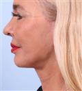 Face Lift - Hermes Clinics