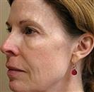 Face Lift - Hermes Clinics