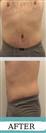Abdominal Liposuction - Hermes Clinics