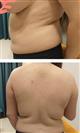 Liposuction - Hermes Clinics