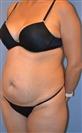 Abdominal Liposuction - Hermes Clinics