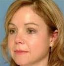 Rhinoplasty - Hermes Clinics