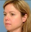 Rhinoplasty - Hermes Clinics