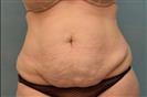 Tummy Tuck - Hermes Clinics