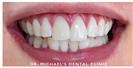Teeth Whitening - Dr. Michael’s Dental Clinics