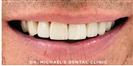 Dental Veneers - Dr. Michael’s Dental Clinics