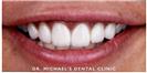 Dental Veneers - Dr. Michael’s Dental Clinics