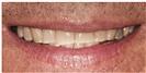 Dental Veneers - Dr. Michael’s Dental Clinics